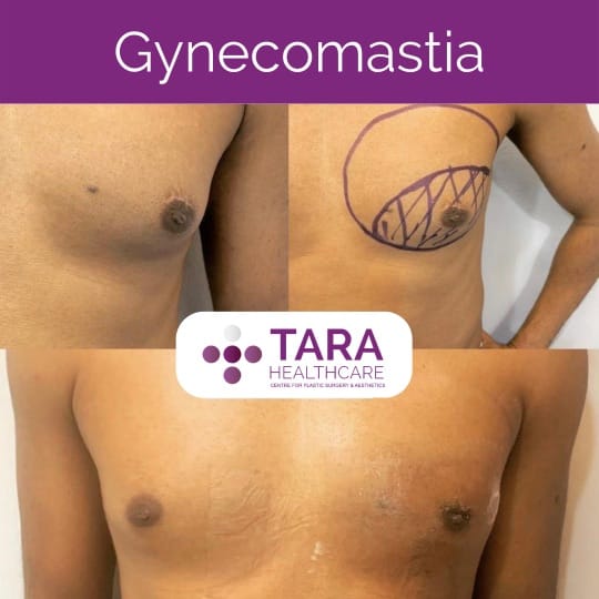 Tara Healthcare Best gynecomatia surgery in bangalore