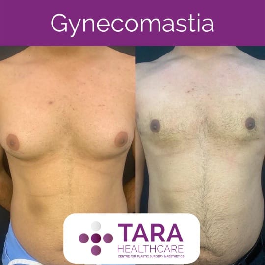 cost os Best gynecomatia surgery in bangalore