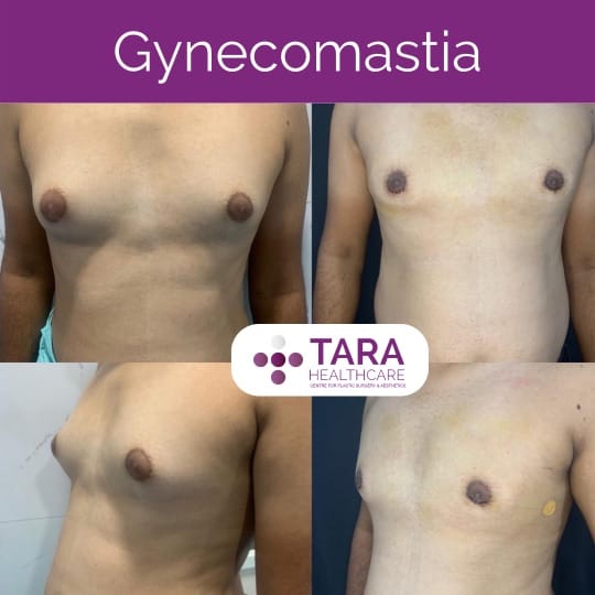 Best gynecomatia surgery in bangalore