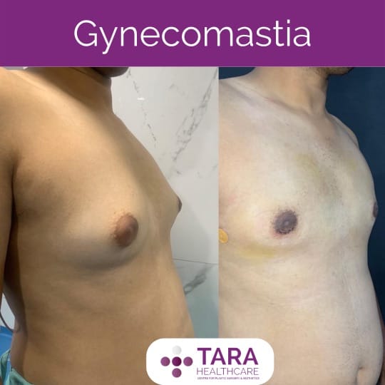 Best gynecomatia surgery in India