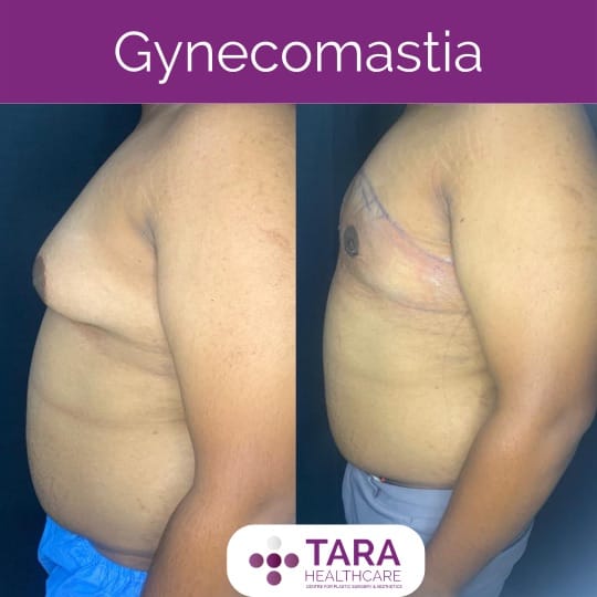 Best gynecomatia hospitalsurgery in bangalore