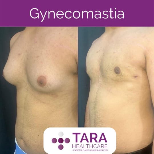 Best gynecomatia clinicsurgery in bangalore