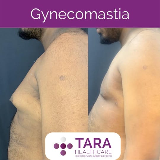 Best gynecomatia top and leading surgery in bangalore