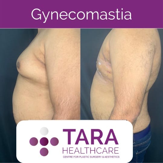 Best gynecomatia surgery in bangalore