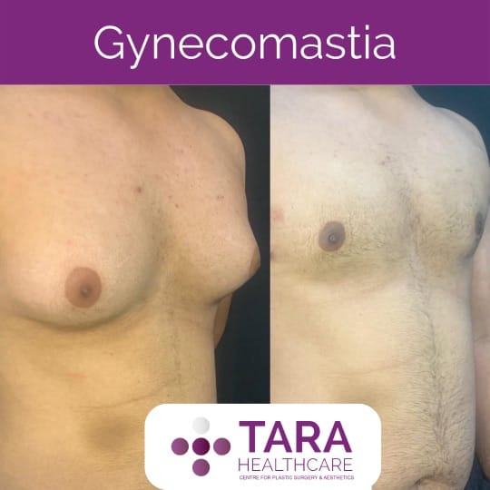 Cost of Best gynecomatia surgery in bangalore