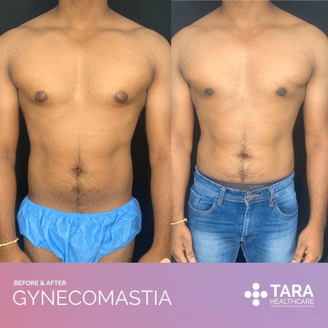 Gynaecomastia 1 1